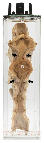 Lye ingestion