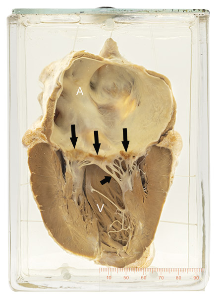 Non-bacterial thrombotic endocarditis