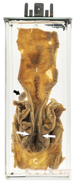 Intussusception