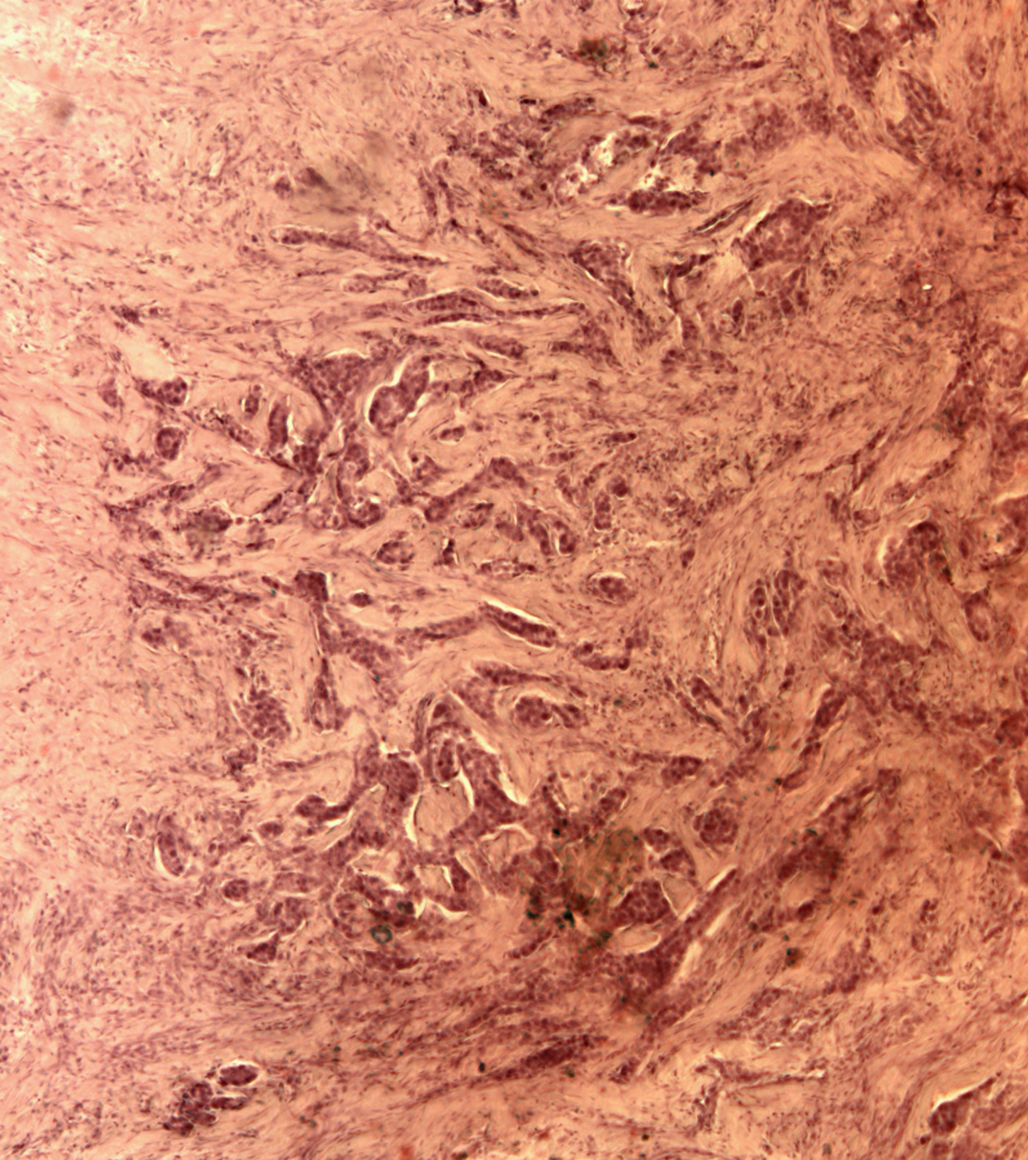 Breast carcinoma histology slide