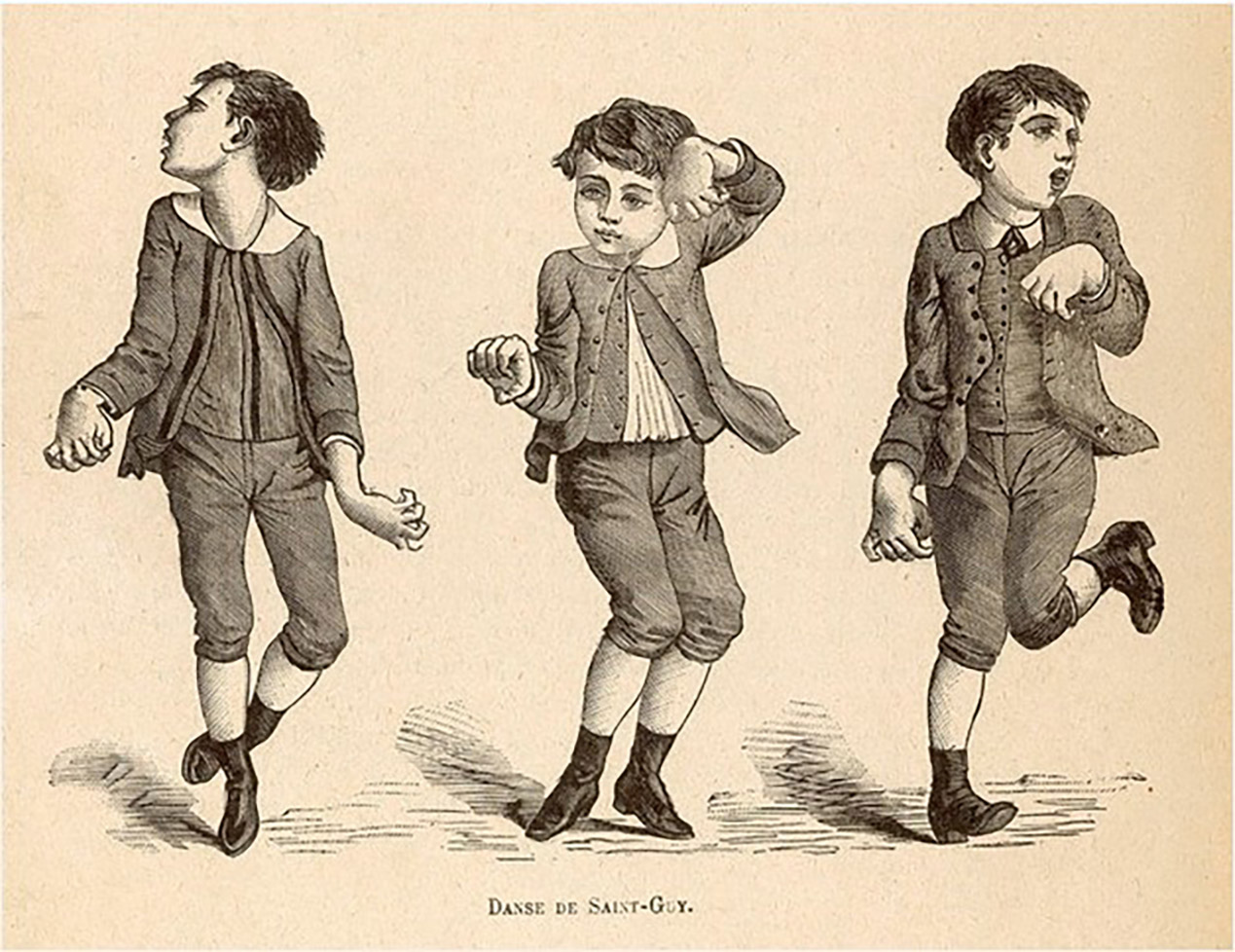 An illustration depicting the dance de Saint Guy, or St. Vitus’s dance, a historical name for Sydenham’s chorea resulting from rheumatic fever. (St. Vitus is the patron saint of dancers.) 