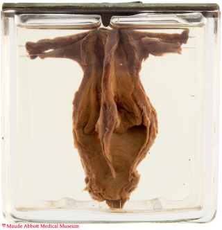 30 Uterus Didelphys Maude Abbott Medical Museum Mcgill University