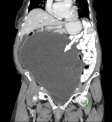 CT scan