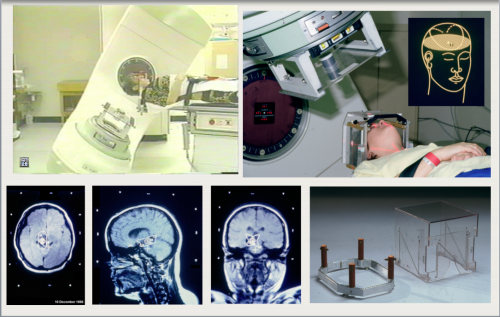 Historical intracranial stereotactic radio-surgery at McGill