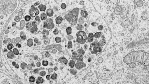 A Lewy body in formation