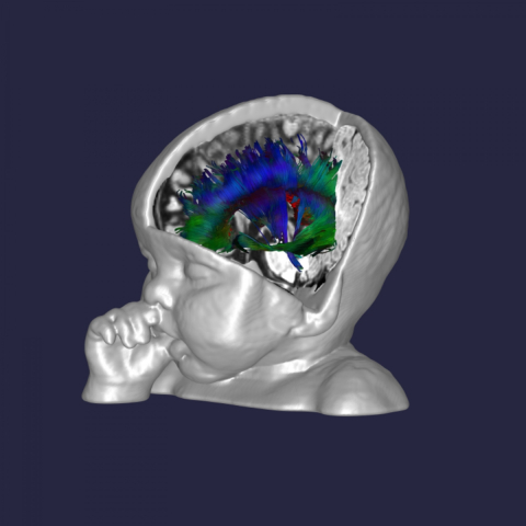 This artwork shows a few of the connections in the brain of a typically developing 6-month infant who participated in the study.  In the study, connections between all brain regions are generated, and the lengths and strengths of the connections are combined to determine the network efficiency of each region.
