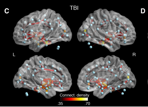 Researchers found that white matter connections between several brain regions of concussed individuals showed abnormal connectivity that might reflect both degeneration and the brain’s method of compensating for damage.