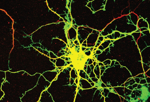 A neuron in culture was transduced with a virus that expresses a green fluorescent protein and an inhibitory RNA that causes loss of the DENND5A protein. The neurons where then stained with a marker of neuronal processes in red.
