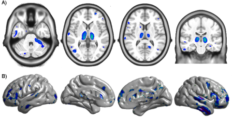 The top row shows brain atrophy, and the bottom row shows cortical thinning in the brain of a person with HIV. 