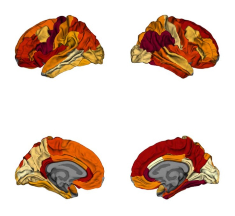 Comparaison de l’épaisseur du cortex entre les cerveaux de patients obèses et ceux de personnes atteintes de la maladie d’Alzheimer. Les couleurs foncées font ressortir les similitudes dans l’épaisseur corticale entre les deux groupes. 