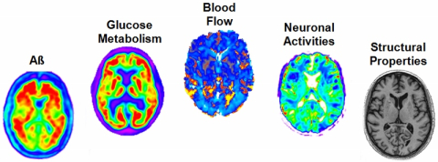 This study used multiple imaging techniques to measure amyloid concentration, glucose metabolism, cerebral blood flow, functional activity and brain atrophy in 78 regions of the brain, covering all grey matter.