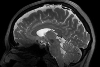An MRI image of the human brain