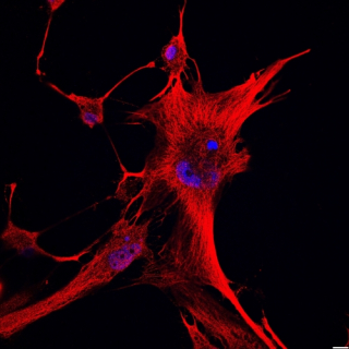 A cell of glioblastoma, a form of brain cancer. 