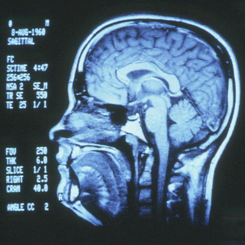 Scan of brain