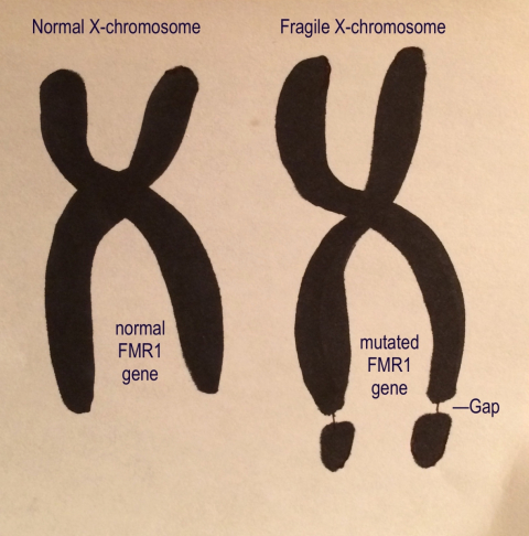 Fragile-X Syndrome