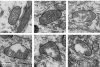 Altération des mitochondries dans la SCA6. Dans les tissus témoins (les trois images du haut), la plupart des mitochondries ont une apparence saine, la membrane interne repliée sur elle-même occupant tout l'espace intérieur. Dans la SCA6 (les trois images du bas), les mitochondries, évidées et lésées, ne jouent plus leur rôle.
