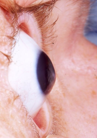 Keratoconus Keratoconus