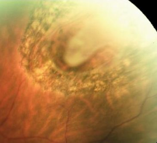 Retinal Tear treated by Laser