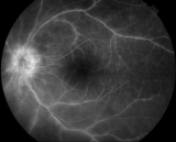 Retinal Angiogram