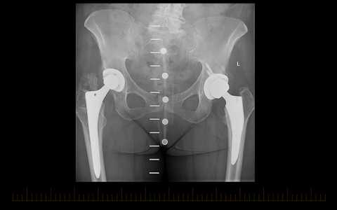 Arthroplasty X-ray