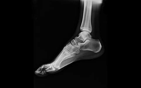 Foot and Ankle X-ray