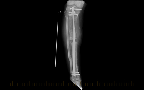 Limb Lengthening X-ray
