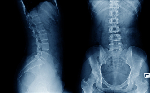 Orthopaedic Spine X-Ray