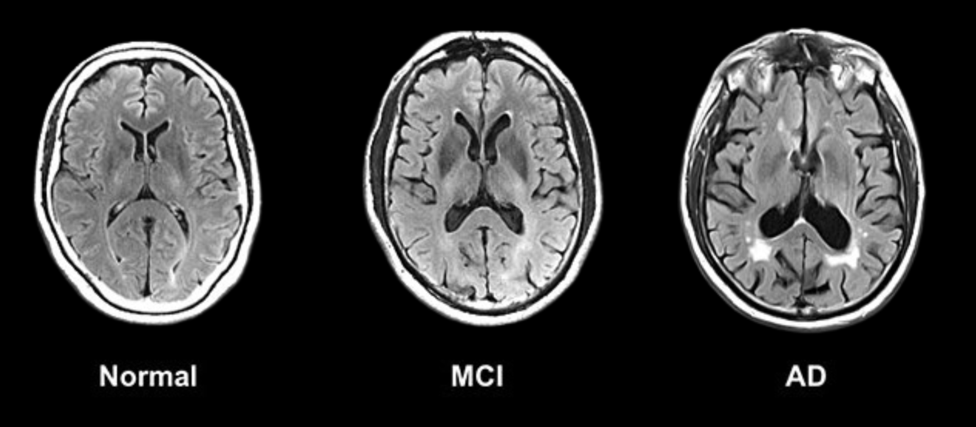 Image comparing 3 brain scans: normal, mild cognitive impairment, and Alzheimer's disease.