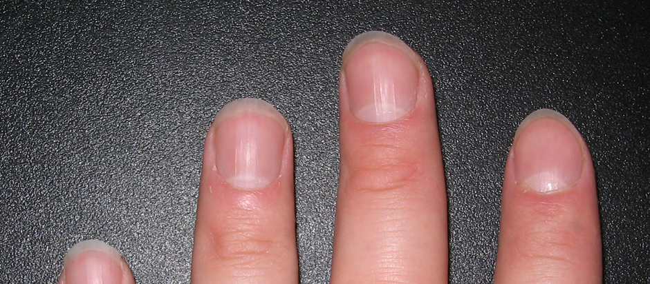 vertical lines on nails