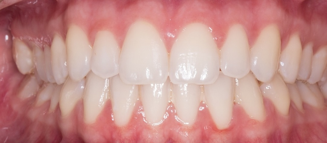 Close-up of teeth biting down.