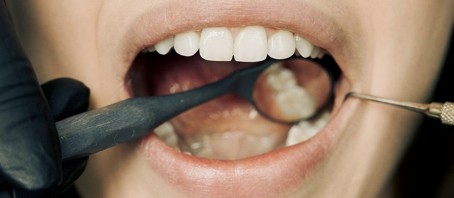 A wide-mouthed patient has their teeth checked.