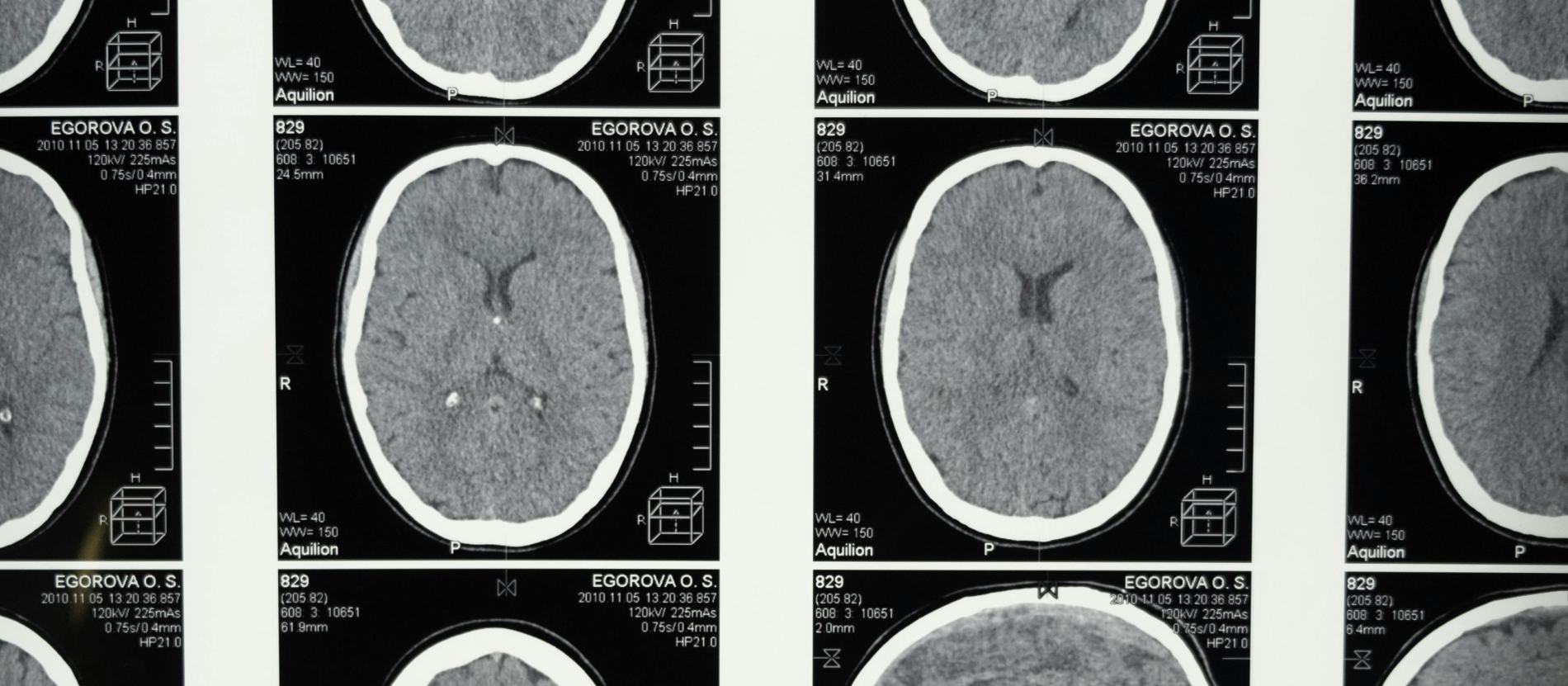 Black and white scans of brain.