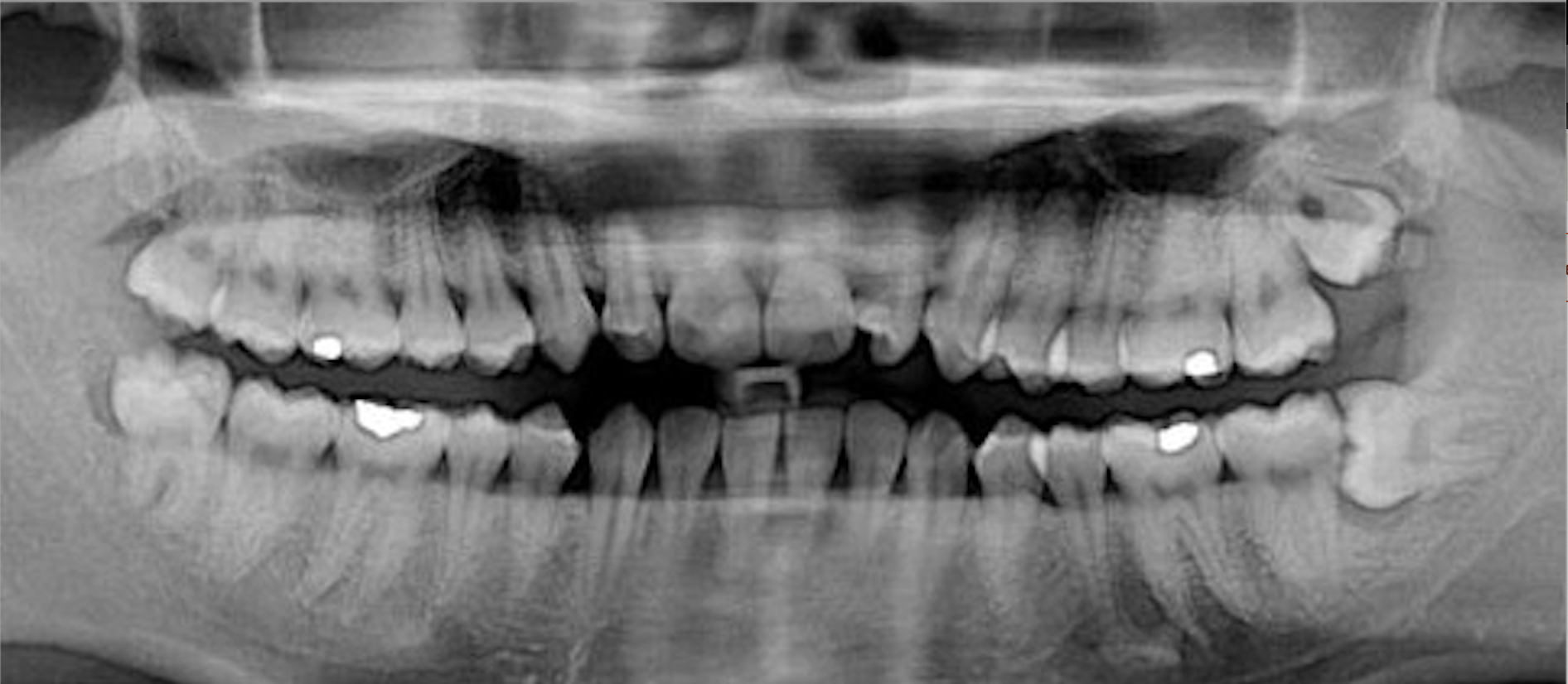 X-ray of upper and lower teeth with glowing spots representing cavities.