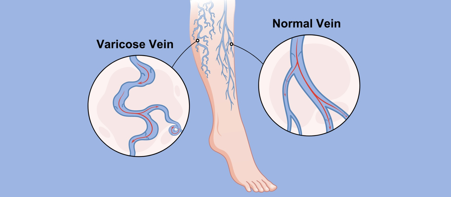 Cartoon drawing comparing normal versus varicose veins.
