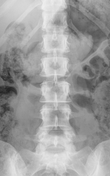 spine x-ray1